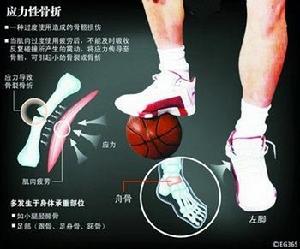 疲劳性骨折