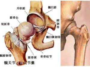 患上股骨头坏死会有那些早期症状
