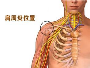 是什么原因诱发了肩周炎的发生