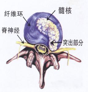 腰椎间盘突出患者的护理是什么样的