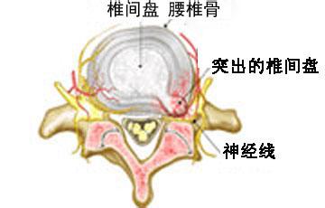引发腰椎间盘突出的原因知多少